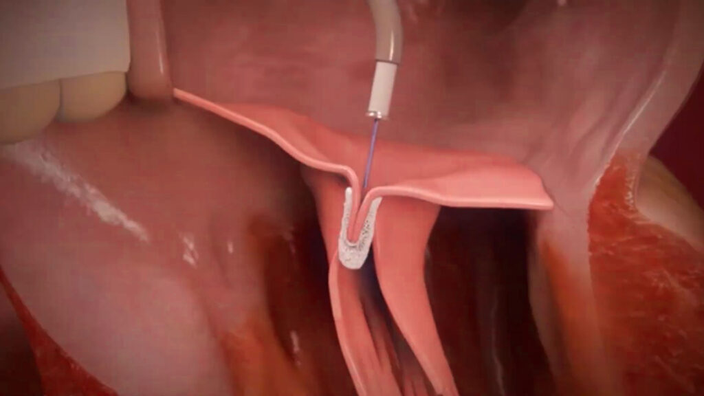 Video of MitraClip procedure